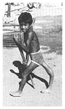 Child with polio whose leg bends back.