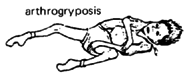 Arthrogryposis.