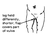 Dislocated hip at birth.