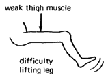 Difficulty lifting leg.