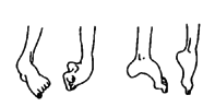 Clubbing or bending of feet may begin as floppy weakness and become stiff from contractures.