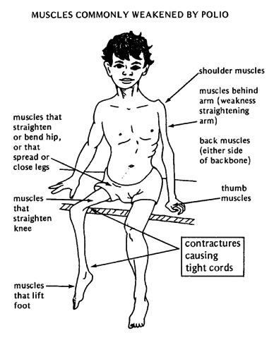 MUSCLES COMMONLY WEAKENED BY POLIO