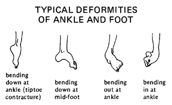 TYPICAL DEFORMITIES OF ANKLE AND FOOT