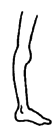 A stiff foot with a moderate tiptoe contracture.