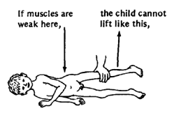 A child with very weak hip muscles.
