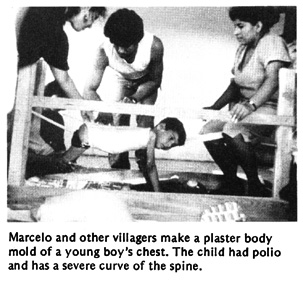 Marcelo and other villagers make a plaster body nold of a young boy's chest. The child had polio and has a severe curve of the spine.