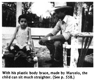 Marcelo and other villagers make a plaster body nold of a young boy's chest. The child had polio and has a severe curve of the spine. (See Page 558)