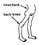 OVER-STRETCHED JOINTS (swayback, back-knee)