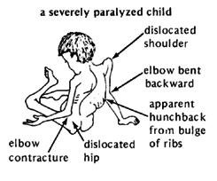 A severely paralyzed child.