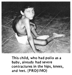 This child, who had polio as a baby, already had severe contractures in the hips, knees, and feet. (PROJIMO)