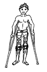Because of hip weakness, he may need long leg braces with a hip band.