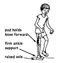 He might be able to walk without the stick if he uses a below-knee brace to stabilize his foot.