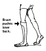 Brace pushes knee back.