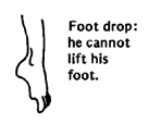Foot drop : he cannot lift his foot.
