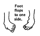 Foot flops to one side.