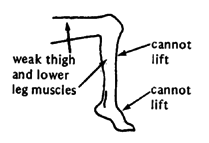 A child's weak knee