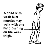 A child with weak butt muscles may walk with one hand pushing on the weak thigh.