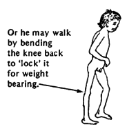 Or he may walk by bending the knee back to 'lock' it for weight bearing.