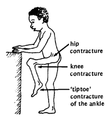  hip contracture, knee contracture, 'tiptoe' contracture of the ankle