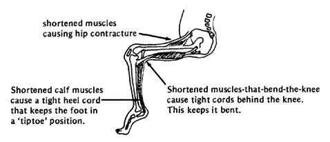 Because of the contractures, Miguel could not stand or walk, even with a brace.