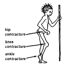 A paralysed limb is kept bent or hanging.