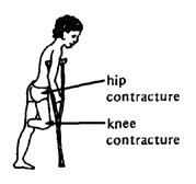 A child with an amputation keeps joints bent.