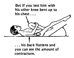 But if you test him with his other knee bent up to his chest ...... his back flattens and you can see the amount of contracture.