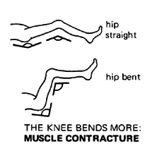 THE KNEE BENDS MORE: MUSCLE CONTRACTURE