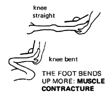 THE FOOT BENDS UP MORE: MUSCLE CONTRACTURE