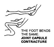 THE FOOT BENDS THE SAME: JOINT CAPSULE CONTRACTURE