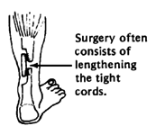Surgery often consists of lengthening the tight cords.