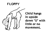 At birth - FLOPPY (Child hangs in upside down 'U' with little or no movement.)
