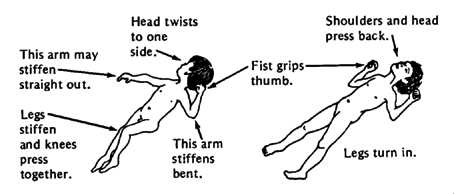 This arm may stiffen straight out. Legs stiffen and knees press together. Head twists to one side. This arm stiffens bent. Fist grips thumb. Shoulders and head press back. Legs turn in.