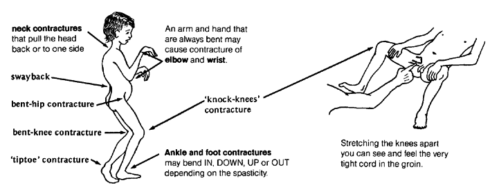 typical contractures of cerebral palsy