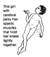 This girl with cerebral palsy has spastic muscles that hold her knees tightly together.