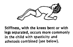  Stiffness, with the knees bent or with legs separated, occurs more commonly in the child with spasticity and athetosis combined (see below).