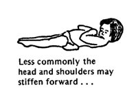 Less commonly the head and shoulders may stiffen forward . . .