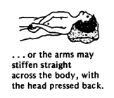. . . or the arms may stiffen straight across the body, with the head pressed back.