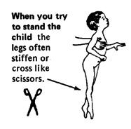 When you try to stand the child the legs often stiffen or cross like scissors.