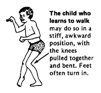 The child who learns to walk may do so in a stiff, awkward position, with the knees pulled together and bent. Feet often turn in.