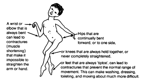 A wrist or elbow that is always bent can lead to contractures (muscle shortening) that make it impossible to straighten the arm or hand. Hips that are continually bent forward, or to one side, or knees that are always hold together, or never completely straightened, or feet that are always 'tiptoe', can lead to contractures that prevent the normal range of movement. This can make washing, dressing, toileting, and moving about much more difficult.