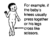  For example, if the baby's knees usually press together or his legs cross like scissors