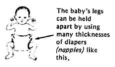 The baby's legs can be held apart by using many thicknesses of diapers (nappies).