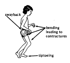 The child stands in an awkward position that can lead to deformities and contractures.