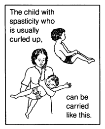 The child with spasticity who is usually curled up, can be carried like this.