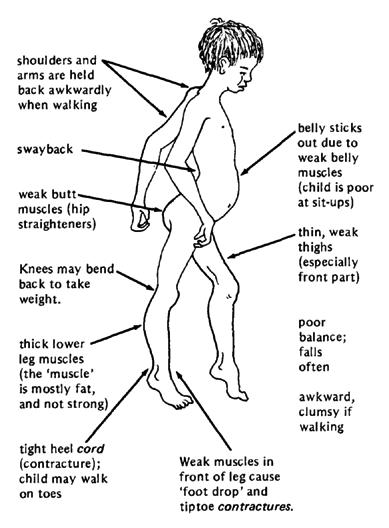 Muscle weakness is caused by muscular dystrophy.