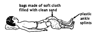 Contractures of the knees.