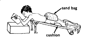 Contractures of the hips.