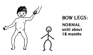 Bow legs: Normal until about 18 months.