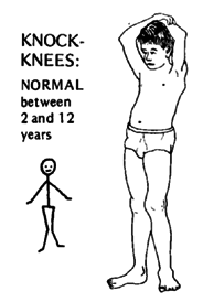 Knok-knees: Normal between 2 and 12 years.